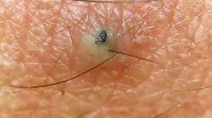 You may also experience pain or itching around the area. Ingrown Youtube