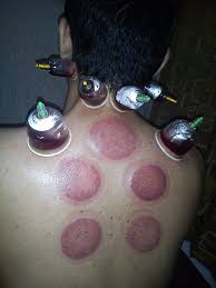 Hijama Wikipedia The Free Encyclopedia Cupping Therapy Cupping Therapy Side Effects Hijama