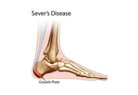 Image result for Calcaneal Apophysitis