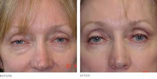 Eyelid Surgery Gallery Eyelid Surgery Surgery Plastic Surgery