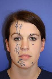 Image result for Forehead Regional Block