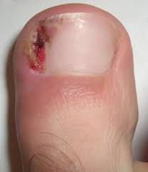 Image result for mykoza nehtů