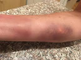 Image result for yellow sac spider bite skin