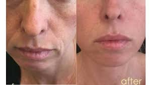 But how fast do those results show up? Sagging Crepey Skin Why Collagen Supplements Can Help