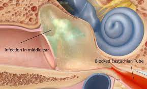 Eustachian Tube Dysfunction - Ear Doctor Los Angeles, Ca Top Otology  Specialist