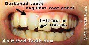 Depending on the damage, you may need a crown, filling, or another restorative. How Do You Know If You Need Root Canal Treatment Signs Symptoms Pain Swelling