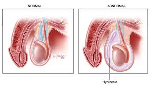 Check with your doctor sounds like it could be an inguinal hernia, and it maybe the bowel is pushing to * the area while you are walking or gravity is pulling area down. Hernia Symptoms Diagnosis Treatment Urology Care Foundation