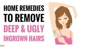 In this article, we will talk about home remedies for ingrown hair. Home Remedies To Get Rid Of Lice Home Remedies Ingrown Hair