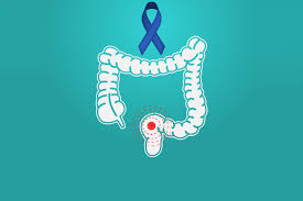 Learn about the common signs of bowel cancer or colorectal cancer with mr muti abulafi. Why Is Colorectal Cancer So Common In Singapore Health Plus