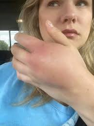 I had a bad wrist injury in January and won't be able to draw properly for  another year, I had a small go at it today but it hurt so badly. This