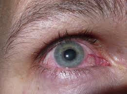 Augen Jucken Und Tranen Das Hat Es Mit Der Augengrippe Auf Sich Kolnische Rundschau