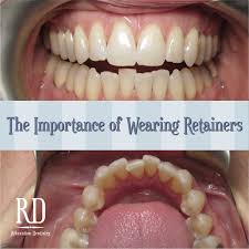 There is no way to repair an essix retainer after it has cracked, so it will need to be replaced. How Long To Wear Retainers Full Time Arxiusarquitectura