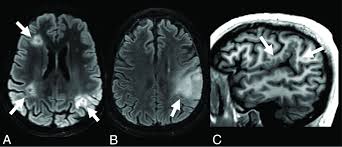 Image result for Incidental Imaging Finding