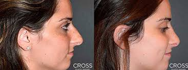 Rhinoplasty (Nose Job)