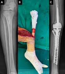 Image result for Osteosarcoma