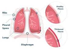 Image result for what is bilateral apical pleural thickening treatment