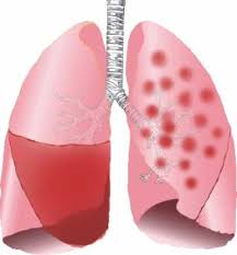 Pneumonie Lungenentzundung Aok Pfiff