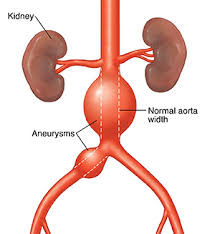 By contrast, false aneurysms are external hematomas with a persistent communication to a leaking artery. Abdominal Aortic Aneurysm Stable Articles Mount Nittany Health System