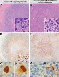 Diagnostic Utility Of Stat6 Ye361 Expression In Classical Hodgkin Lymphoma And Related Entities Modern Pathology