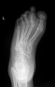 Image result for Osteomyelitis XRay