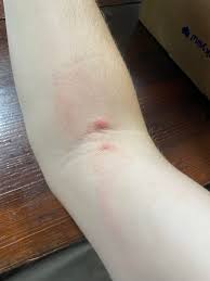 Image result for mite bites on humans