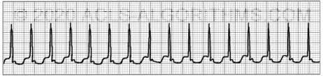 Paroxysmal supraventricular tachycardia (psvt) is a type of supraventricular tachycardia, named for its intermittent episodes of abrupt onset and termination. Supraventricular Tachycardia Svt Acls Algorithms Com