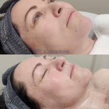 Dermaplaning uses a sterile surgical scalpel to gently exfoliate the skin's  surface, removing dead skin cells and fine vellus hair, commonly known as  "peach fuzz." ​​​​​​​​​​​​​​​​​​This non-invasive procedure not only  promotes a
