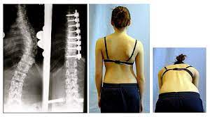 It is usually done during the process of. Skoliose Wikipedia