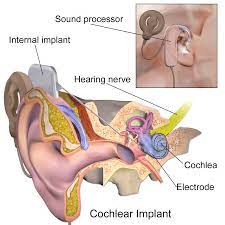 A cochlear implant is a complex hearing device that consists of two parts. Cochlear Implant Wikipedia
