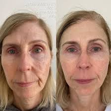 KrX Youthplex Face Lift Cream