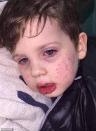 Mother S Warning After Her Three Year Old Catches The Herpes Virus After Being Kissed By A Relative Daily Mail Online
