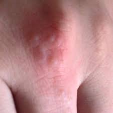 Image result for spinne biss haut reaktion