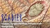 Begitu juga jika nak hilangkan biasa akibat dipatuk ular, digigit anjing ataupun serangga. Apa Itu Kudis Buta Scabies Ubat Dan Cara Merawat Kudis Buta Youtube