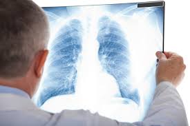 Image result for lung cancer xray