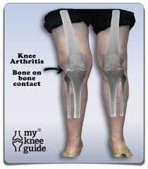 Bow Legs Joanne Has Severe Arthritis On The Outside Of Her Knee Leading To A Knocked Knee Deformity Looking For Bow Legged Correction Bow Legged Knock Knees