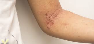 Conditia este frecvent inrautatita sau colonizata de. Intertriginous Dermatitis Intertrigo Kenyan News