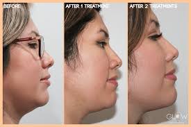 Your cost not only includes the price of the product, but more importantly, the skill and expertise of the healthcare professional who is how many people have been treated with kybella®? Kybella Glow Aesthetic Center