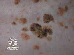 Seborrhoeic keratoses (brown warts, basal cell papillomas, seborrheic  keratosis)