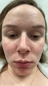 Hi folks, I was told that using moisturizer