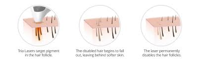 Plus i'll let you in on the best laser hair removal i ain't going to lie to you, it's a long and arduous process, but read my review of the tria beauty hair removal 4x laser and i'll let you know how i get. Amazon Com Tria Beauty Hair Removal Laser 4x For Women And Men Fuchsia Hrl Premium Beauty