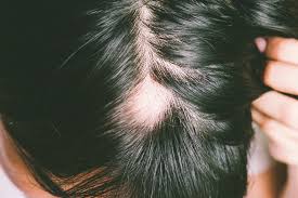 Excessive shedding of hair, but not complete baldness, after various illnesses and drug treatments, rapid weight loss, anemia, or stress. Understanding Alopecia Areata Hair Loss Treatments Philip Kingsley