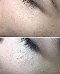 Wiele osób myli je z wypryskami lub zaskórnikami. Usuwanie Prosakow Warszawa Szybko Sprawnie W Healthybeauty