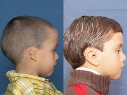 Microtia Treatment From An Expert Surgeon In Beverly Hills