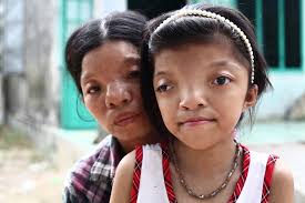 Usaid and vietnam's military science department sign a memorandum of intent for cooperation on dioxin remediation of the bien hoa airbase area. A Mother And Daughter Second And Third Generation Agent Orange Victims In Da Nang Vietnam Drew Brown