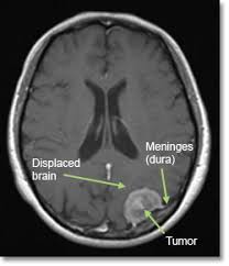 meningioma brain tumor