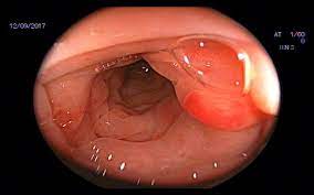 A) of a general nature, 1. Divertikelkrankheit