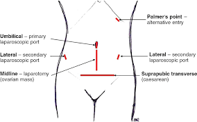 Veress needle first will be used for insufflation and tests of safety will be considered. Basic Open General Surgical Techniques Module 1 Basic Practical Skills In Obstetrics And Gynaecology