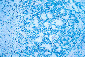 Signs and symptoms of childhood liver cancer include a lump or pain in the abdomen. Neuroblastoma Wikipedia