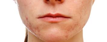 Image result for acne face