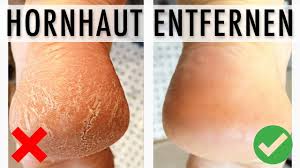 Maizena es gibt eine ganze reihe von hausmittel, die effektiv rissige hornhaut entfernen. 5 Moglichkeiten Hornhaut Zu Entfernen Hornhaut Entfernen Youtube